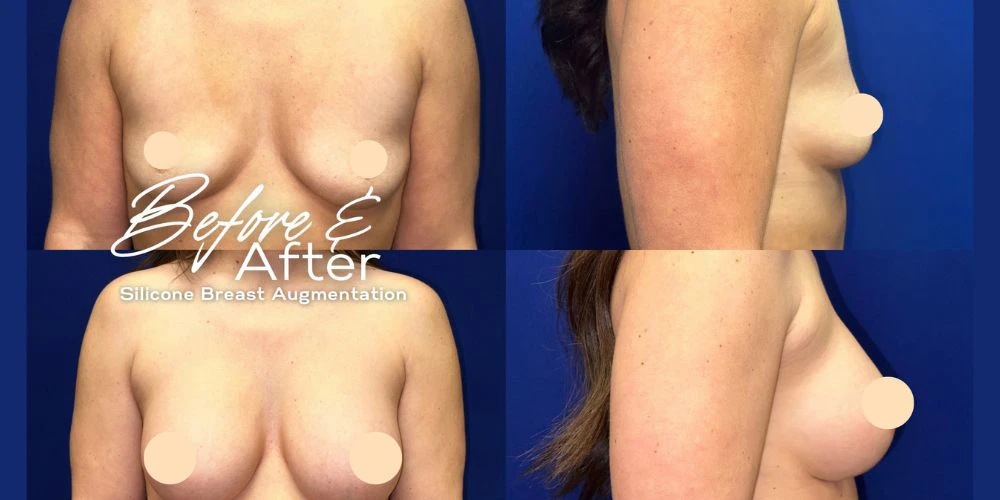 A Lift in Confidence: Transforming Breast Aesthetics
